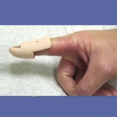 MALLET FINGER