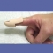 MALLET FINGER